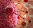 5 самых распространенных видов рака и их симптомы