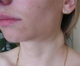 Внешняя среда и хронический лимфаденит Внешняя среда и хронический лимфаденит