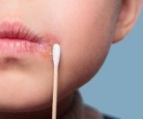 Лабиальный герпес: 10 эффективных рецептов народной медицины Лабиальный герпес: 10 эффективных рецептов народной медицины