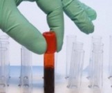 Риск инсульта теперь можно выявить самостоятельно