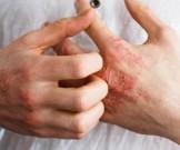 Ученые назвали доступное средство, которое поможет вылечиться от экземы