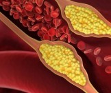 Натуральные средства для профилактики и лечения атеросклероза: 15 рецептов Натуральные средства для профилактики и лечения атеросклероза: 15 рецептов