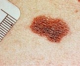 Рак кожи: симптомы, которые не стоит игнорировать Рак кожи: симптомы, которые не стоит игнорировать