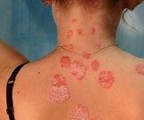 Псориаз: 5 простых натуральных средств в помощь! Псориаз: 5 простых натуральных средств в помощь!