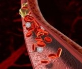 Тромб в легких: 7 симптомов, которые нельзя пропустить Тромб в легких: 7 симптомов, которые нельзя пропустить