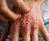 Сарсапарель поможет вылечить псориаз: натуральный рецепт