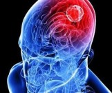 Лечение глиомы в Израиле Лечение глиомы в Израиле