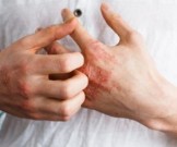 4 лучших домашних средства от кожной аллергии 4 лучших домашних средства от кожной аллергии
