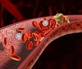 7 опасных симптомов тромбоза, которые нельзя игнорировать 7 опасных симптомов тромбоза, которые нельзя игнорировать
