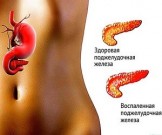 Панкреатит: как уберечь поджелудочную железу Панкреатит: как уберечь поджелудочную железу