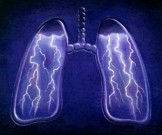 7 ранних симптомов туберкулёза, которые нельзя пропустить 7 ранних симптомов туберкулёза, которые нельзя пропустить
