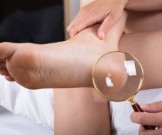 5 скрытых болезней, которые сопровождаются трещинами на пятках