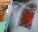 8 самых распространенных симптомов рака легких 8 самых распространенных симптомов рака легких