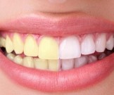 Как отбелить зубы естественным способом всего за 2 минуты Как отбелить зубы естественным способом всего за 2 минуты