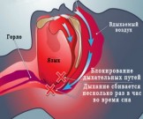 Как избавиться от храпа: простые упражнения Как избавиться от храпа: простые упражнения