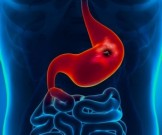 8 действенных народных средств для борьбы с язвенной болезнью