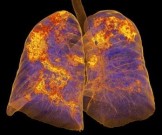 Коронавирус серьезно поражает легкие, а симптомов может не быть — инфекционист Коронавирус серьезно поражает легкие, а симптомов может не быть — инфекционист